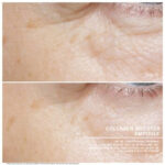 collagen booster before after